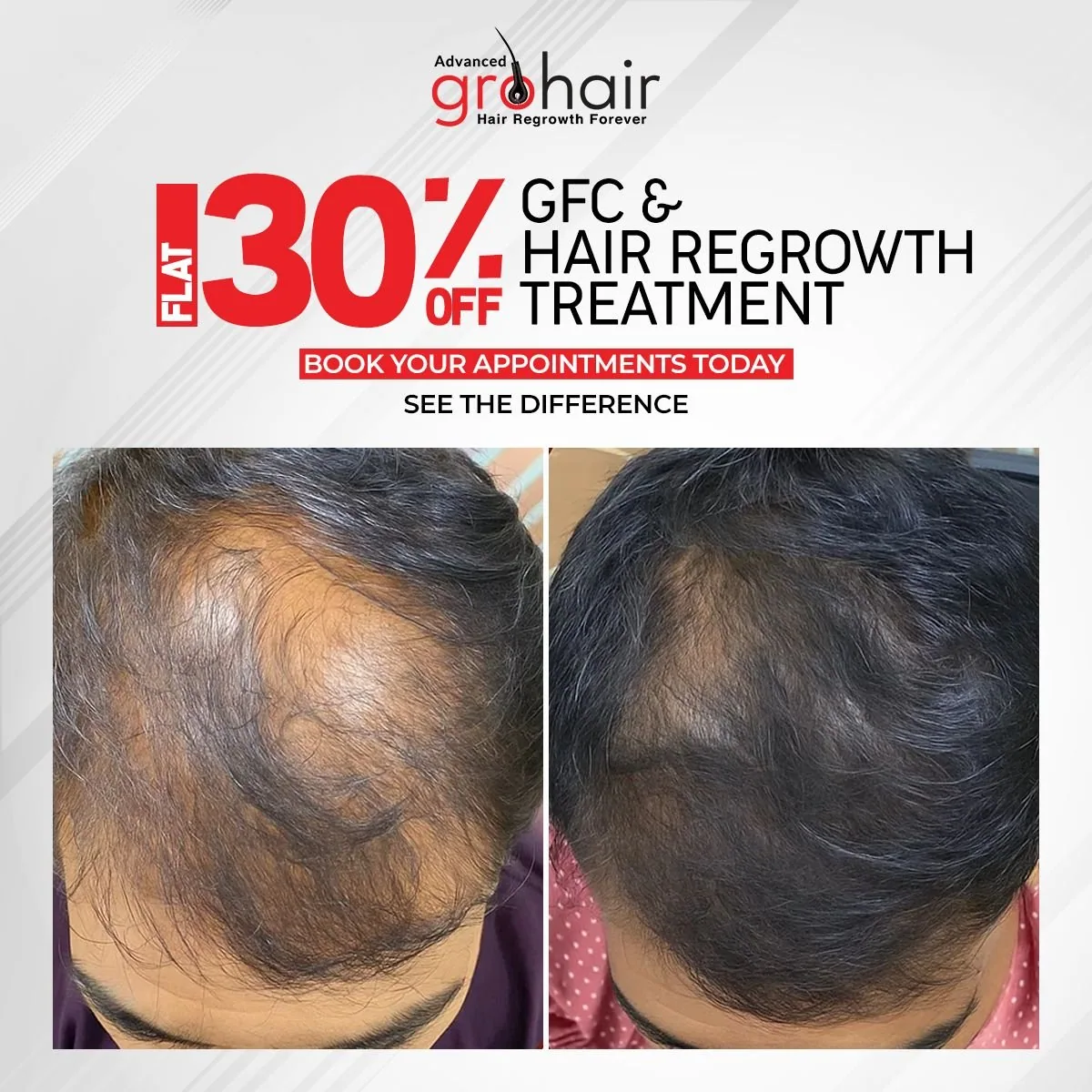 Flat 30% off OLT and anti-dandruff treatment